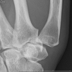 母指CM関節症、中手骨骨切り術、関節固定術（治療前）