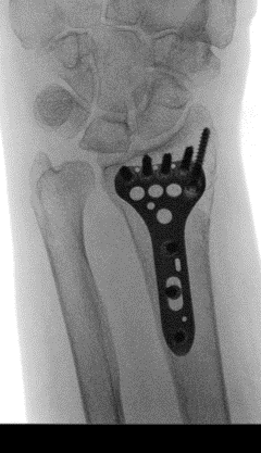 橈骨遠位端骨折②術後